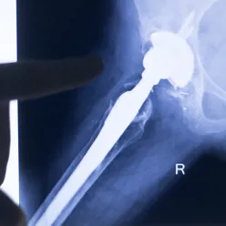 En røntgen av en person
